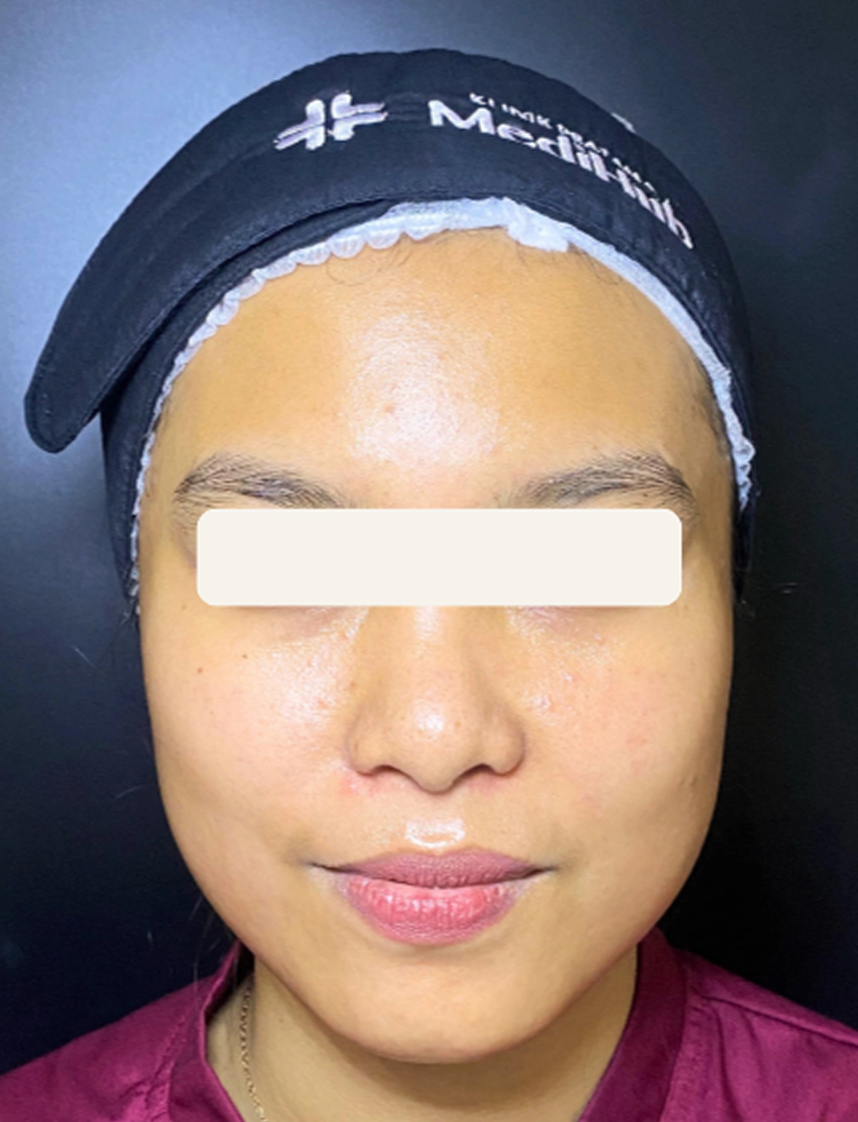 After Facial Platinum Peel