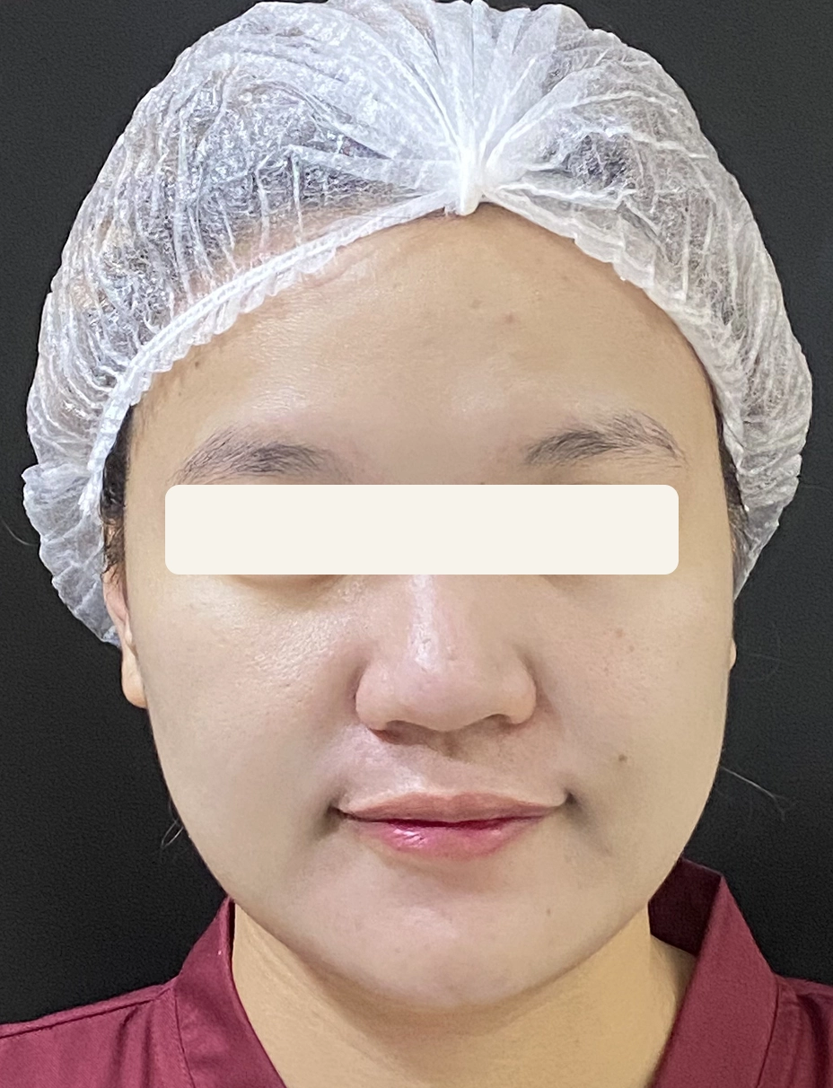After Facial Basic