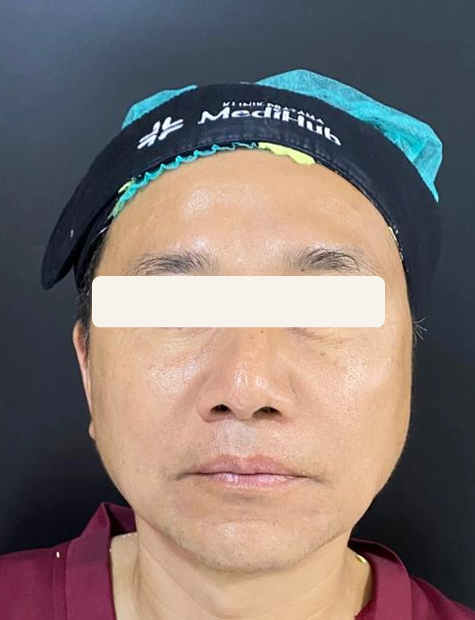 After Facial Galvanic dan Oxy