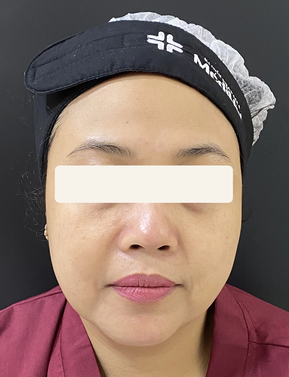 After Laser Nd-Yag dan Peeling Lightening