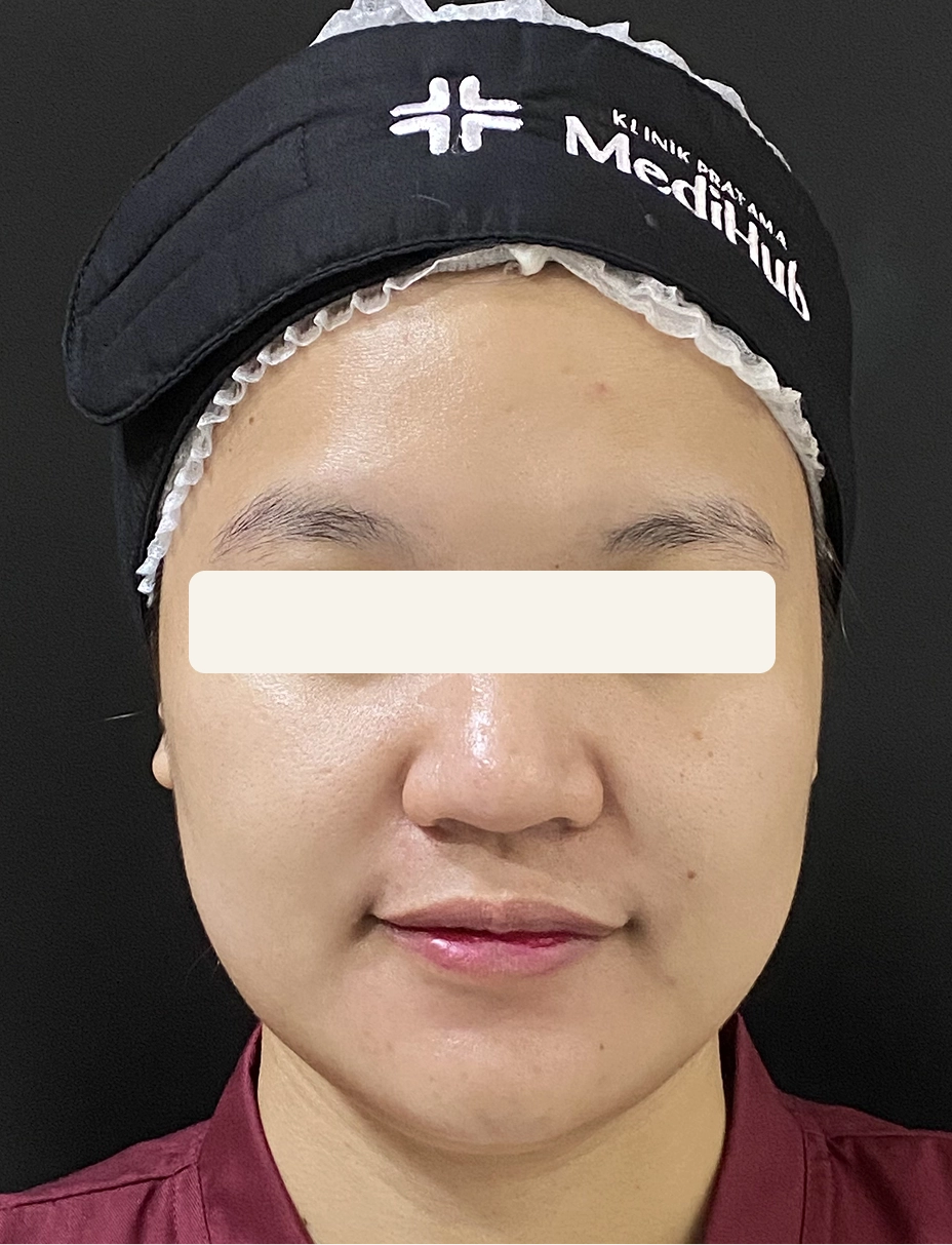 Before Facial Basic