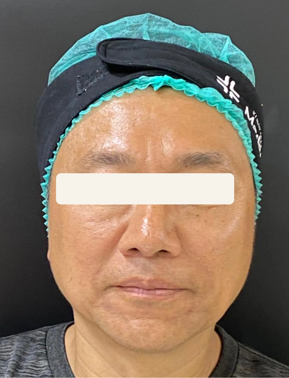 Before Facial Galvanic dan Oxy