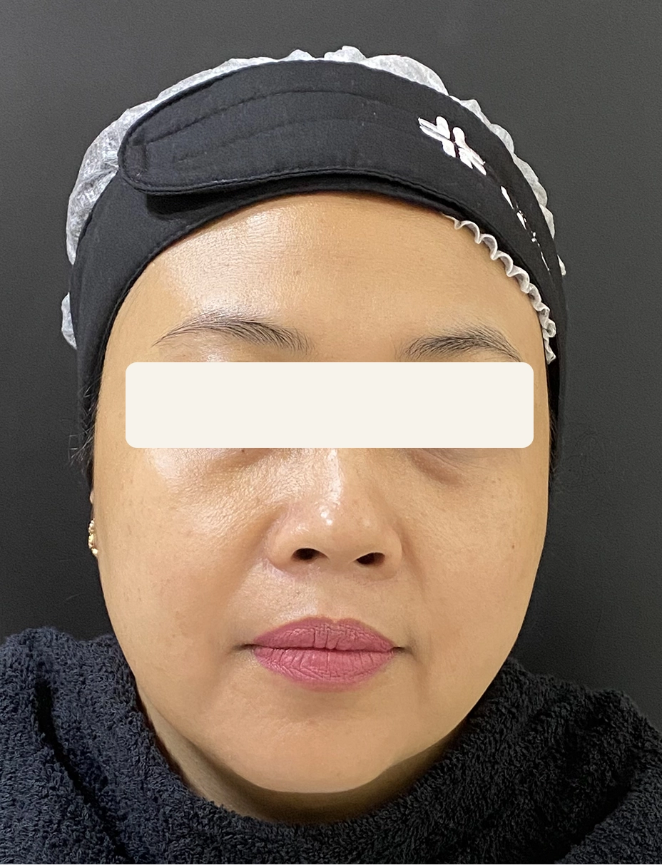 Before Laser Nd-Yag dan Peeling Lightening