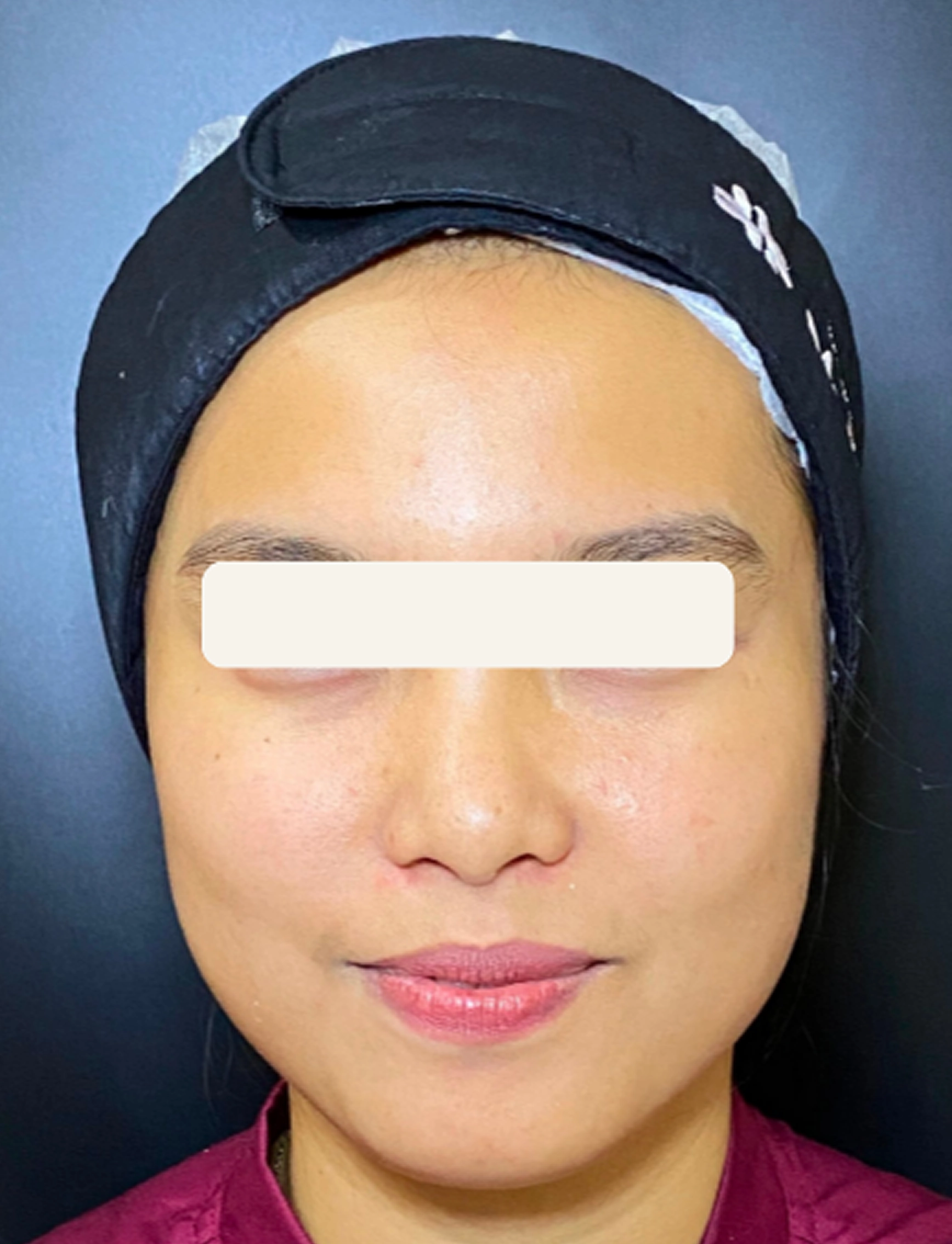 Before Facial Platinum Peel