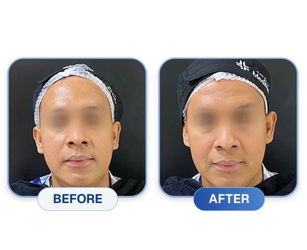 Before After promo Glow Renewal Program